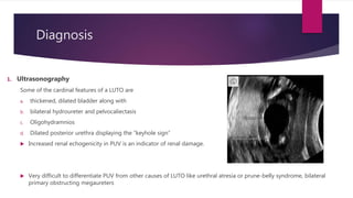 Diagnosis
1. Ultrasonography
Some of the cardinal features of a LUTO are
a. thickened, dilated bladder along with
b. bilateral hydroureter and pelvocaliectasis
c. Oligohydramnios
d. Dilated posterior urethra displaying the “keyhole sign”
 Increased renal echogenicity in PUV is an indicator of renal damage.
 Very difficult to differentiate PUV from other causes of LUTO like urethral atresia or prune-belly syndrome, bilateral
primary obstructing megaureters
 