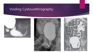 Voiding Cystourethrography
 