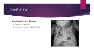 Chest Xrays
 Bronchopulmonary dysplasia
 Reduced lung volume
 left upper and lower lobe atelectasis
 