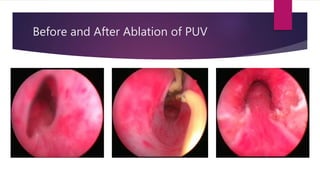 Before and After Ablation of PUV
 