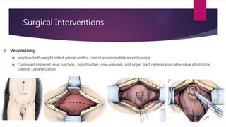 Surgical Interventions
2. Vesicostomy
 very low-birth-weight infant whose urethra cannot accommodate an endoscope
 Continued impaired renal function, high bladder urine volumes, and upper tract deterioration after valve ablation or
urethral catheterization
 