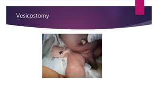 Vesicostomy
 