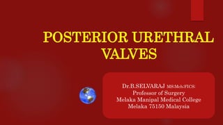 POSTERIOR URETHRAL
VALVES
Dr.B.SELVARAJ MS;Mch;FICS;
Professor of Surgery
Melaka Manipal Medical College
Melaka 75150 Malaysia
 
