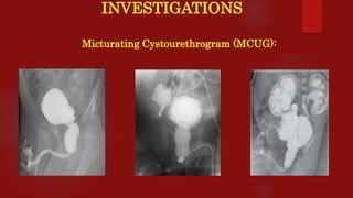 INVESTIGATIONS
Micturating Cystourethrogram (MCUG):
 