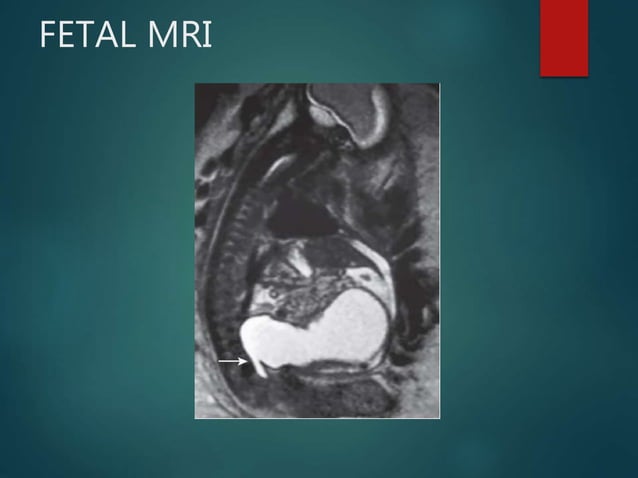 POSTERIOR URETERAL VALVES (PUV ) | PPTX