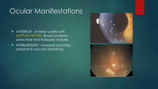 Ocular Manifestations
 ANTERIOR : Anterior uveitis with
MUTTON FAT KPs ,Broad posterior
synechiae and Koeppes nodules
 INTERMEDIATE : snowball opacities,
peripheral vascular sheathing
 