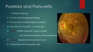 Posterior and Panuveitis
1. Choroid Tubercles
 It is the most recognized feature
 Occurs due to hematogenous spread
 Less than 5 in number ,1-2 mm in size
 Active: Whitish yellowish to grey nodule
with ill defined borders in the posterior pole
 Healed : Pigmented and atrophic scar
 Associated with hyperemic disc
 