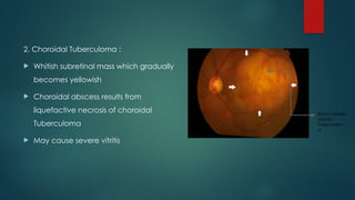2. Choroidal Tuberculoma :
 Whitish subretinal mass which gradually
becomes yellowish
 Choroidal abscess results from
liquefactive necrosis of choroidal
Tuberculoma
 May cause severe vitritis
Blood vessels
above
Tuberculom
a
 