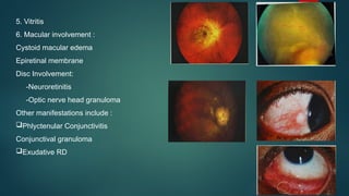 5. Vitritis
6. Macular involvement :
Cystoid macular edema
Epiretinal membrane
Disc Involvement:
-Neuroretinitis
-Optic nerve head granuloma
Other manifestations include :
Phlyctenular Conjunctivitis
Conjunctival granuloma
Exudative RD
 