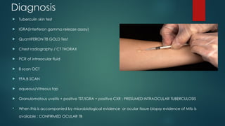 Diagnosis
 Tuberculin skin test
 IGRA(interferon gamma release assay)
 QuantiFERON TB GOLD Test
 Chest radiography / CT THORAX
 PCR of intraocular fluid
 B scan OCT
 FFA,B SCAN
 aqueous/Vitreous tap
 Granulomatous uveitis + positive TST/IGRA + positive CXR : PRESUMED INTRAOCULAR TUBERCULOSIS
 When this is accompanied by microbiological evidence or ocular tissue biopsy evidence of Mtb is
available : CONFIRMED OCULAR TB
 