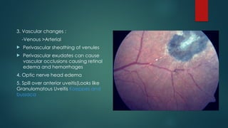 3. Vascular changes :
-Venous >Arterial
 Perivascular sheathing of venules
 Perivascular exudates can cause
vascular occlusions causing retinal
edema and hemorrhages
4. Optic nerve head edema
5. Spill over anterior uveitis(Looks like
Granulomatous Uveitis Koeppes and
bussaca
 