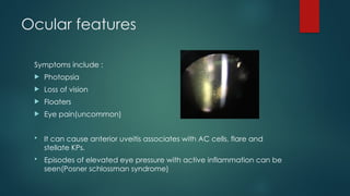 Ocular features
Symptoms include :
 Photopsia
 Loss of vision
 Floaters
 Eye pain(uncommon)
 It can cause anterior uveitis associates with AC cells, flare and
stellate KPs.
 Episodes of elevated eye pressure with active inflammation can be
seen(Posner schlossman syndrome)
 