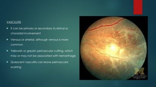 VASCULITIS
 It can be primary or secondary to retinal or
choroidal involvement
 Venous or arterial, although venous is more
common
 Yellowish or greyish perivascular cuffing, which
may or may not be associated with hemorrhage
 Quiescent vasculitis can leave perivascular
scarring
 
