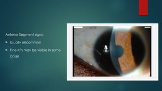 Anterior Segment signs:
 Usually uncommon
 Fine KPs may be visible in some
cases
 