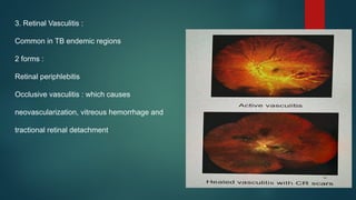 3. Retinal Vasculitis :
Common in TB endemic regions
2 forms :
Retinal periphlebitis
Occlusive vasculitis : which causes
neovascularization, vitreous hemorrhage and
tractional retinal detachment
 