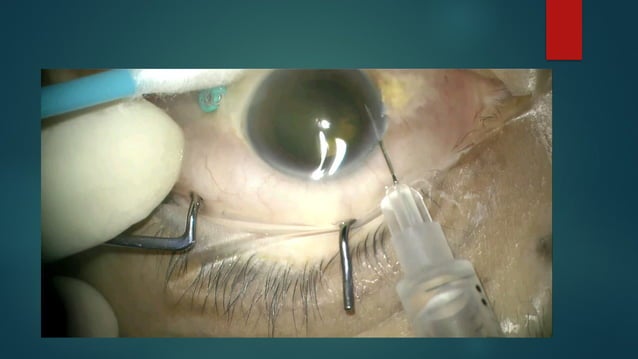 Posterior uveitis (Infective causes) Ophthalmology | PPTX