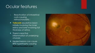 Ocular features
1. Reactivation of intraretinal
cysts causing
retinochoroiditis :
 Yellowish exudative lesion
initially involving the inner
retina and later involving full
thickness of retina.
 There is reactive
inflammation of underlying
choroid.
 Healed lesions can cause
RPE hypertrophy causing
Retinochoroidal scars
 