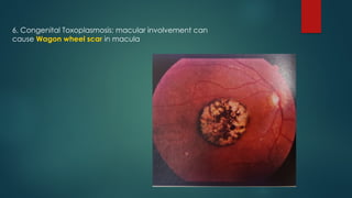 6. Congenital Toxoplasmosis: macular involvement can
cause Wagon wheel scar in macula
 