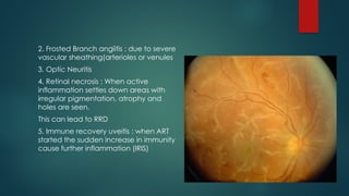 2. Frosted Branch angiitis : due to severe
vascular sheathing(arterioles or venules
3. Optic Neuritis
4. Retinal necrosis : When active
inflammation settles down areas with
irregular pigmentation, atrophy and
holes are seen.
This can lead to RRD
5. Immune recovery uveitis : when ART
started the sudden increase in immunity
cause further inflammation (IRIS)
 