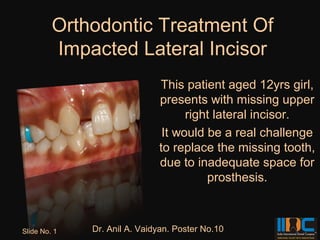 Orthodontic Treatment Of
         Impacted Lateral Incisor
                              This patient aged 12yrs girl,
                              presents with missing upper
                                    right lateral incisor.
                               It would be a real challenge
                              to replace the missing tooth,
                              due to inadequate space for
                                        prosthesis.



Slide No. 1   Dr. Anil A. Vaidyan. Poster No.10
 