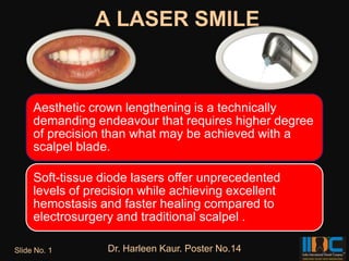 A LASER SMILE



     Aesthetic crown lengthening is a technically
     demanding endeavour that requires higher degree
     of precision than what may be achieved with a
     scalpel blade.

     Soft-tissue diode lasers offer unprecedented
     levels of precision while achieving excellent
     hemostasis and faster healing compared to
     electrosurgery and traditional scalpel .

Slide No. 1       Dr. Harleen Kaur. Poster No.14
 
