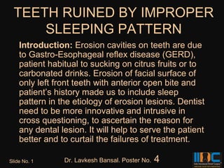 TEETH RUINED BY IMPROPER
     SLEEPING PATTERN
    Introduction: Erosion cavities on teeth are due
    to Gastro-Esophageal reflex disease (GERD),
    patient habitual to sucking on citrus fruits or to
    carbonated drinks. Erosion of facial surface of
    only left front teeth with anterior open bite and
    patient’s history made us to include sleep
    pattern in the etiology of erosion lesions. Dentist
    need to be more innovative and intrusive in
    cross questioning, to ascertain the reason for
    any dental lesion. It will help to serve the patient
    better and to curtail the failures of treatment.

Slide No. 1     Dr. Lavkesh Bansal. Poster No.   4
 