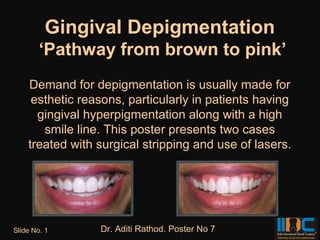 Gingival Depigmentation
        ‘Pathway from brown to pink’
    Demand for depigmentation is usually made for
     esthetic reasons, particularly in patients having
      gingival hyperpigmentation along with a high
       smile line. This poster presents two cases
    treated with surgical stripping and use of lasers.




Slide No. 1      Dr. Aditi Rathod. Poster No 7
 