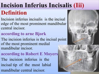 Postero anterior cephalometric _ mansoura university _ Egypt | PPTX