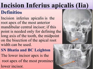 Postero anterior cephalometric _ mansoura university _ Egypt | PPTX