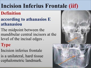 Postero anterior cephalometric _ mansoura university _ Egypt | PPTX