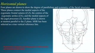 Horizontal planes
Four planes are drawn to show the degree of parallelism and symmetry of the facial structures.
Three planes connect the medial aspects of the
zygomatic frontal sutures (Z-Z), the centres of the
zygomatic arches (ZA), and the medial aspects of
the jugal processes (J). Another plane is drawn
at menton parallel to the Z plane. MSR has been
selected as a true vertical reference line.
Orthodontics: Diagnosis and Management of Malocclusion
and Dentofacial Deformities
 