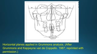 Horizontal planes applied in Grummons analysis. (After
Grummons and Kappeyne van de Coppello. 1987; reprinted with
permission.)
 
