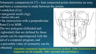 Volumetric comparison (6.17) - four connected points determine an area,
and here a connection is made between the points:
• condylion (Co);
• antegonial notch (Ag);
• menton (Mc) and
• the intersection with a perpendicular
from Co to MSR.
The two polygons (leftsided and
rightsided) that are defined by these
points can be superimposed with the
aid of a computer program, and
a percentile value of symmetry can be
obtained. Volumetric comparison applied in Grummons analysis. (After Grummons and
Kappeyne van de Coppello, 1987; reprinted with permission.)
 