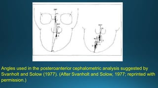 Angles used in the posteroanterior cephalometric analysis suggested by
Svanholt and Solow (1977). (After Svanholt and Solow, 1977; reprinted with
permission.)
 