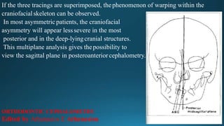 If the three tracings are superimposed, thephenomenon of warping within the
craniofacialskeleton can be observed.
In most asymmetric patients, the craniofacial
asymmetry will appear lesssevere in the most
posterior and in the deep-lyingcranial structures.
This multiplane analysis gives thepossibility to
view the sagittal plane in posteroanteriorcephalometry.
ORTHODONTIC CEPHALOMETRY
Edited by Athanasios E Athanasiou
 