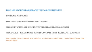 LONG LEG STANDING RADIOGRAPHS TO EVALUATE ALIGNMENT
IN CHRONIC PLC INJURIES
PRIMARY VARUS - TIBIOFEMORAL MALALIGNMENT
SECONDARY VARUS - LCL DEFICIENCY WITH INCREASED LATERAL OPENING
TRIPLE VARUS – REMAINING PLC DEFICIENT, OVERALL VARUS RECURVATUM ALIGNMENT
NECESSORY TO DETERMINE MECHANICAL AXISAND IF A PROXIMAL TIBIAL OSTEOTOMY FOR
CORRECTION
 