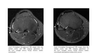 Axial T2-weighted fat-suppressed MR images show the
normal course and MR imaging appearance of
the LCL (straight arrow), biceps femoris tendon
(arrowhead).
Axial T2-weighted fat-suppressed MR images show the
normal course and MR imaging appearance of
the LCL (straight arrow), biceps femoris tendon
(arrowhead), and popliteus tendon (wavy arrow).
 