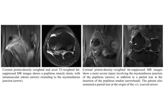 Coronal proton-density–weighted and axial T2-weighted fat-
suppressed MR images shows a popliteus muscle strain, with
intramuscular edema (arrow) extending to the myotendinous
junction (arrow)
Coronal proton-density–weighted fat-suppressed MR images
show a more severe injury involving the myotendinous junction
of the popliteus (arrow), in addition to a partial tear at the
insertion of the popliteus tendon (arrowhead). The patient also
sustained a partial tear at the origin of the LCL (curved arrow)
 
