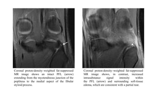 Coronal proton-density–weighted fat-suppressed
MR image shows an intact PFL (arrow)
extending from the myotendinous junction of the
popliteus to the medial aspect of the fibular
styloid process.
Coronal proton-density–weighted fat-suppressed
MR image shows, in contrast, increased
intrasubstance signal intensity within
the PFL (arrow) and surrounding soft-tissue
edema, which are consistent with a partial tear.
 