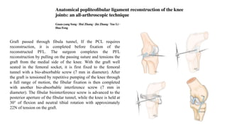 Graft passed through fibula tunnel, If the PCL requires
reconstruction, it is completed before fixation of the
reconstructed PFL. The surgeon completes the PFL
reconstruction by pulling on the passing suture and tensions the
graft from the medial side of the knee. With the graft well
seated in the femoral socket, it is first fixed to the femoral
tunnel with a bio-absorbable screw (7 mm in diameter). After
the graft is tensioned by repetitive pumping of the knee through
a full range of motion, the fibular fixation is then completed
with another bio-absorbable interference screw (7 mm in
diameter). The fibular biointerference screw is advanced to the
posterior aperture of the fibular tunnel, while the knee is held at
30° of flexion and neutral tibial rotation with approximately
22N of tension on the graft.
 