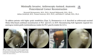 To address patients with higher grade instabilities (Type 3), Hermanowicz et al. described an arthroscopic-assisted
fibula-/tibia-based combined reconstruction of PLC and LCL in 2019. Reconstructing both ligaments required two
autologous tendon grafts (semitendinosus tendon for PLT, gracilis tendon for LCL).
 