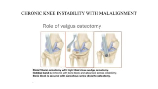 CHRONIC KNEE INSTABILITY WITH MALALIGNMENT
 