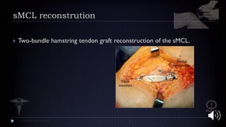 Posteromedial Corner (PMC) and Medial Collateral ligamnet (MCL ...