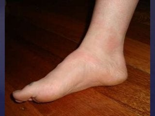 Post Gardasil Skin & Inflammatory Reactions - Patient ZVK 