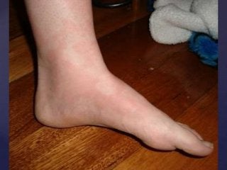 Post Gardasil Skin & Inflammatory Reactions - Patient ZVK 