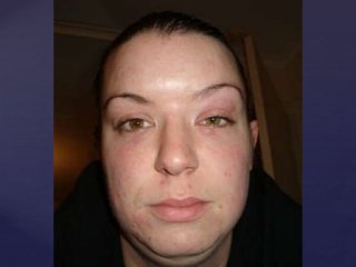 Post Gardasil Skin & Inflammatory Reactions - Patient ZVK 