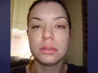 Post Gardasil Skin & Inflammatory Reactions - Patient ZVK 