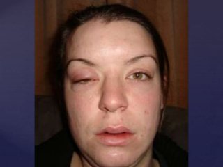 Post Gardasil Skin & Inflammatory Reactions - Patient ZVK 