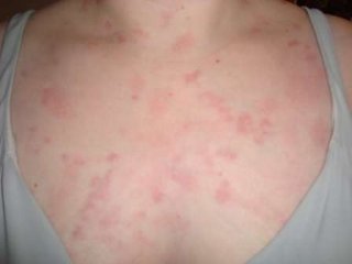 Post Gardasil Skin & Inflammatory Reactions - Patient ZVK 