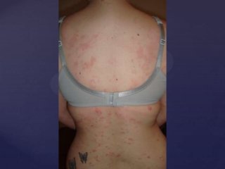 Post Gardasil Skin & Inflammatory Reactions - Patient ZVK 